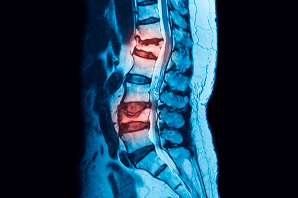 Fracturas Vertebrales Osteoporóticas